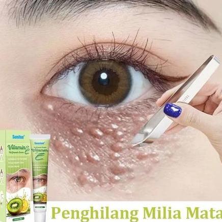 krim penghilang milia syringoma xanthelasma butiran lemak sekitar mata