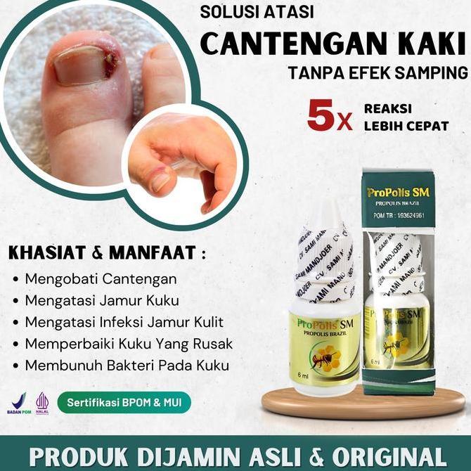 Obat Sakit Cantengan Kuku Jari Jempol Kaki Bengkak Bernanah - Propolis