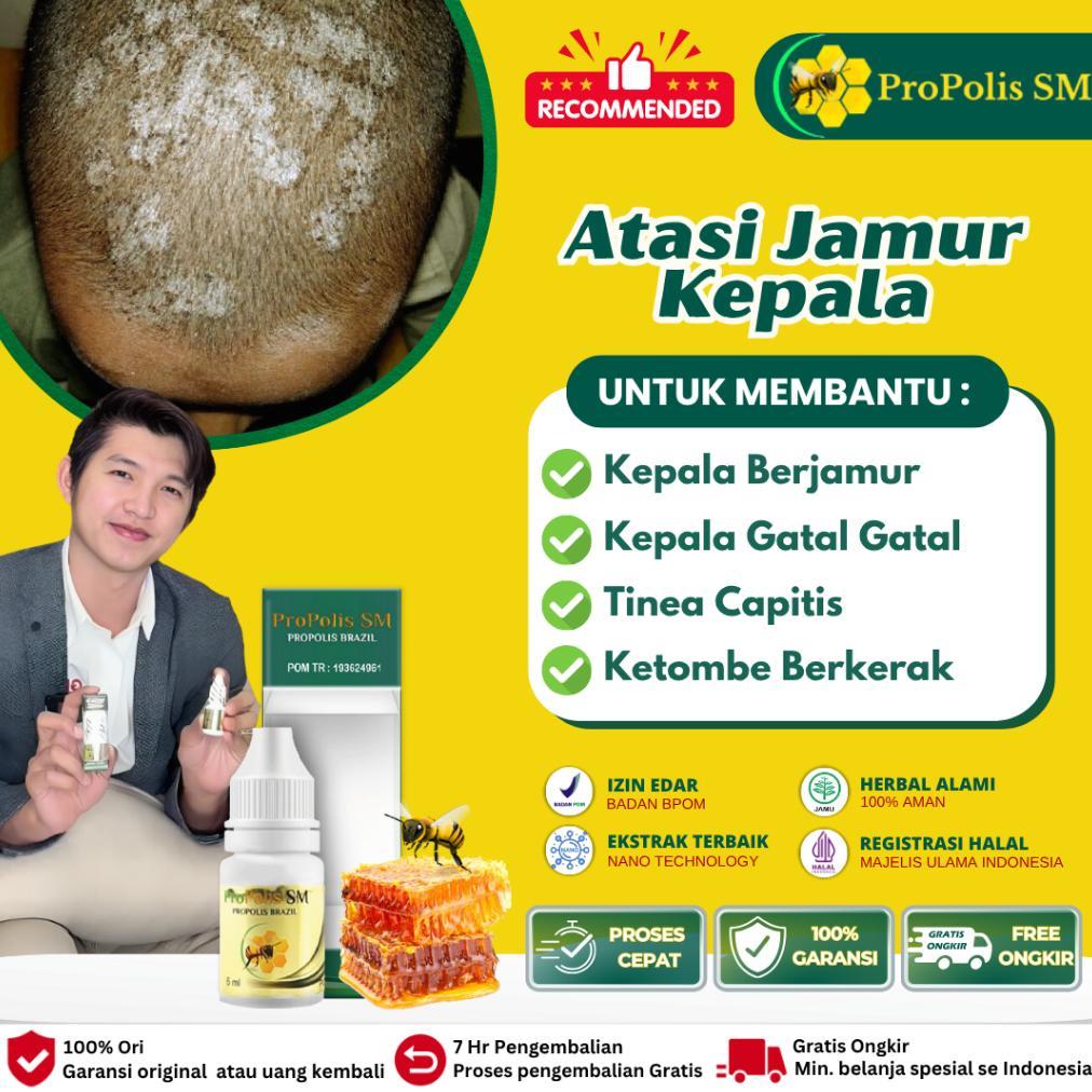 Obat Kurap Jamur di kulit Kepala, Kulit Kepala Berjamur, Kulit Kepala Gatal Berjamur, Obat Kepala Bo