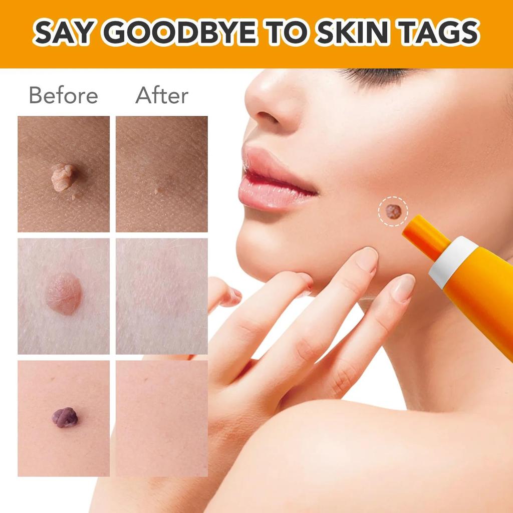 Micro Skin Tag Remover Auto Wart Removal Kit Cleaning Skin Tag Removal Mole Removal Machine Body Fac