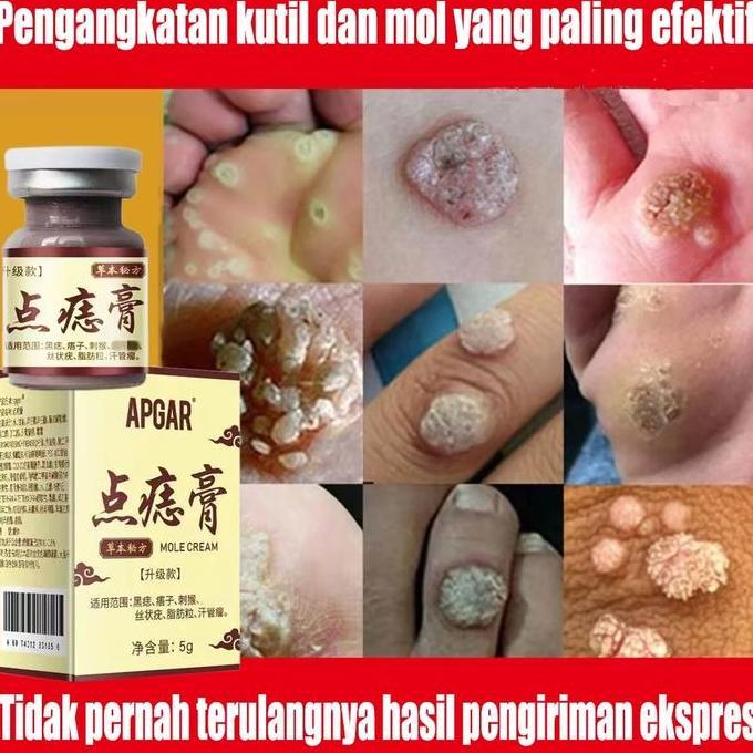 Efek Bagus Obat Kutil Paling Ampuh Oles Penghilang Kutil Manjur Tanpa Operasi Mahal Penghapus Mengha