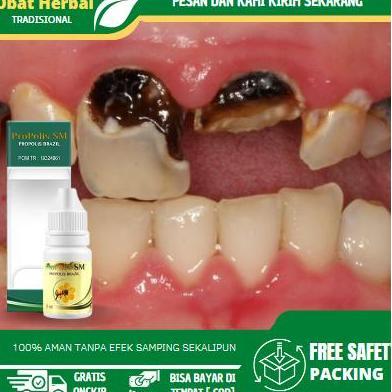 Cairan Tetes Untuk Mengatasi Gigi Rusak, Gigi Hitam, Gigi Berlubang, Gigi Keropos, Gigi Sensitif, Sa