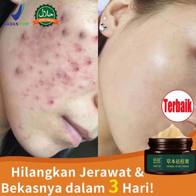Krim Penghilang Jerawat Bpom Qianzi Obat Totol Jerawat Ampuh / Mengurangi Jerawat Batu & Bruntusan /