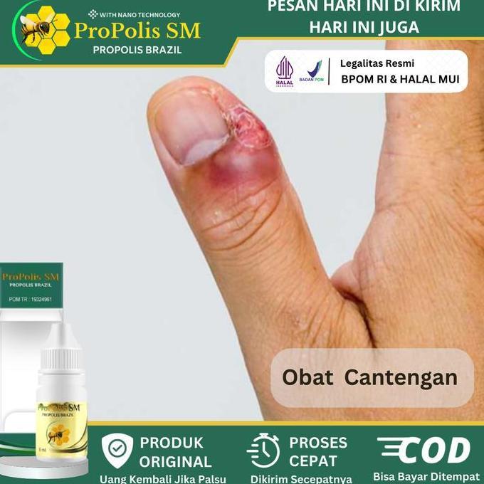 Mengobati Cantengan Jempol Kuku Kaki Dan Tangan, Kuku Bengkak Bernanah Nyeri Bau Busuk, Tetes Kuku C