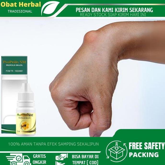 Solusi Untuk Mengatasi Benjolan Di Tangan, Kista Ganglion,  Benjolan Lipoma, Benjolan Di Pergelangan
