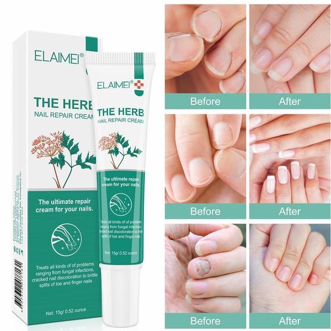 15g Salep Jamur Kuku Tangan Obat Kuku Jamur Salep Kuku Jamur Dan Rusak Obat Kuku Busuk