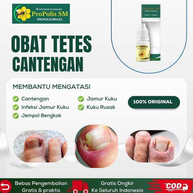Perawatan Cantengan Jempol Kaki, Jamur Kuku Rusak, Psoriasis Kuku Jempol Bengkak, Kuku Cantengan - P