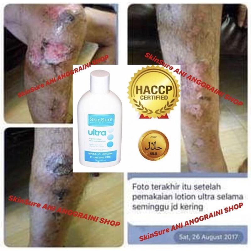 Salep Krim Obat Gatal Original Ampuh Penyakit Kulit Eksim Scabies Herpes Gatal Selangkangan Kutu Air