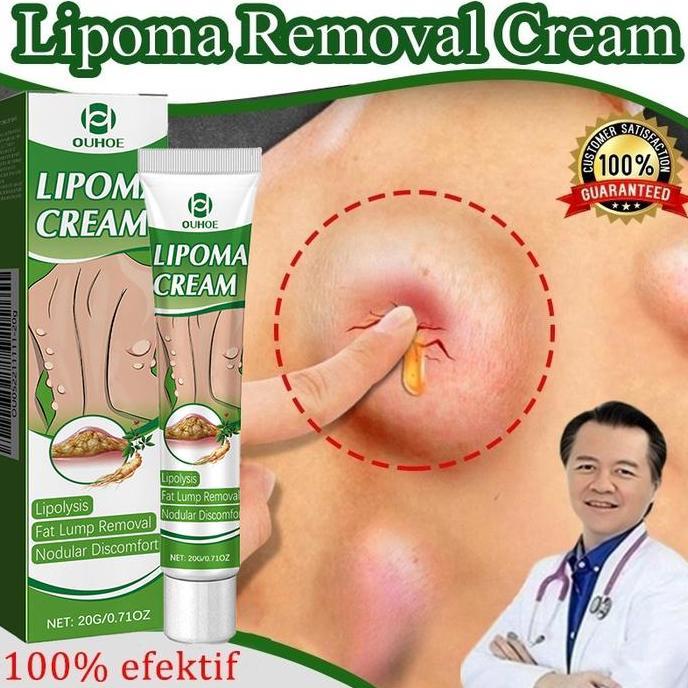 Murah Lipoma Cream Obat Benjolan Subkutan Lipoma Removal Cream Obat Salep Benjolan Lipoma Ampuh Herb
