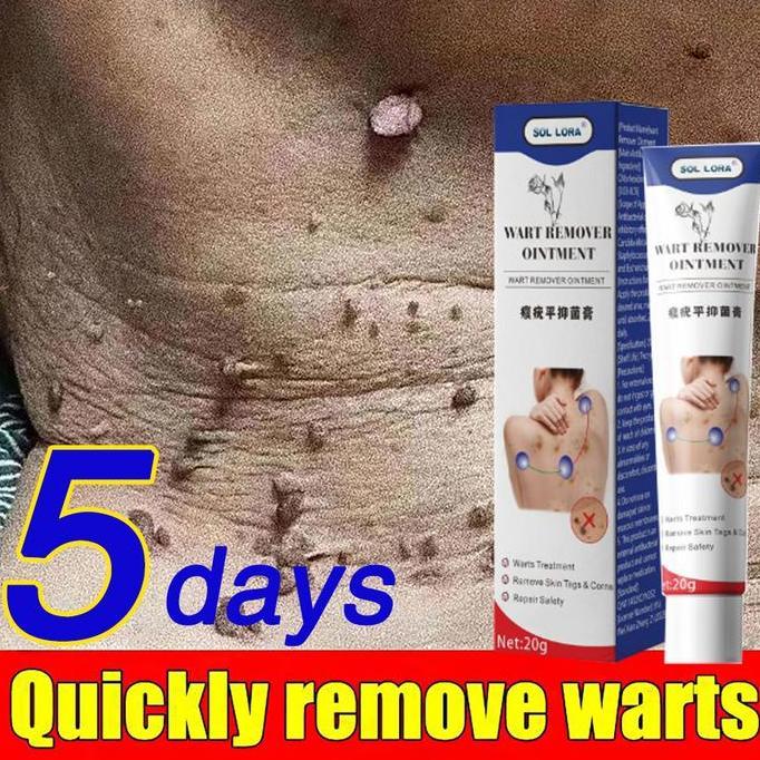 Bytxc- Efek Bagus Obat Kutil Paling Ampuh Oles Penghilang Kutil 20G Manjur Tanpa Operasi Mahal Pengh