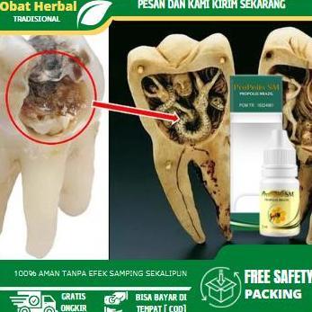 Cairan Tetes Pembunuh Ulat Gigi, Ulat Dalam Gigi Yang Berlubang, Cara Mengeluarkan Ulat Gigi, Pember