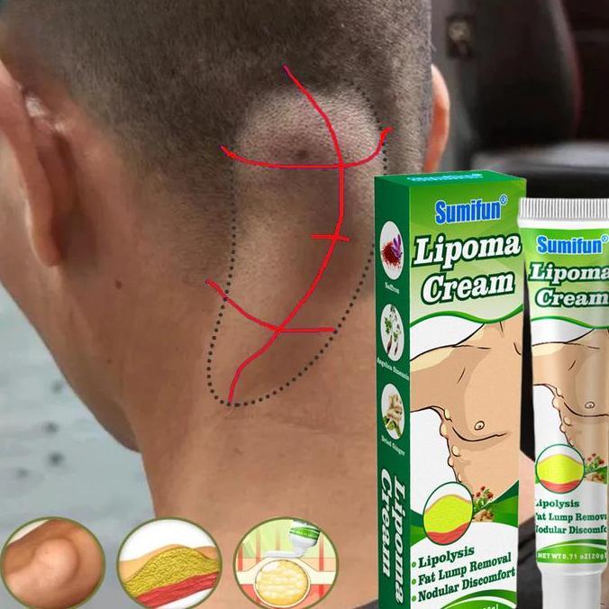 Lipoma Cream 20G / Obat Untuk Benjolan 100% Efektif Lipoma Removal Cream Original Allshop