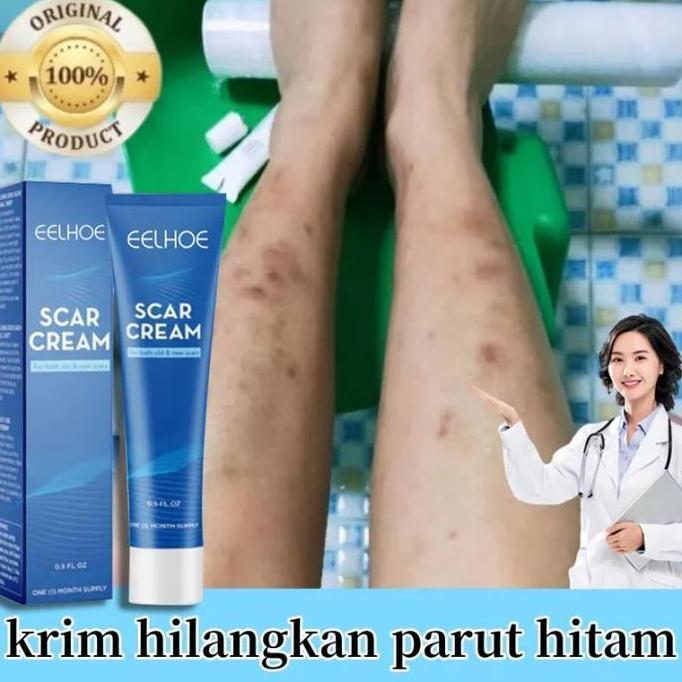 Eelhoe Salep Bekas Luka Penghilang Bekas Koreng Hitam Obat Keloid Paling Ampuh Salep Penghilang Beka