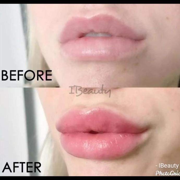 New- Lip Plumper/Filler Bibir [BARUU]