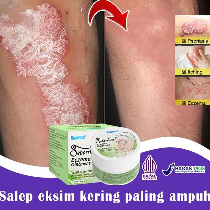 Bytwoi- BpomSalep Eksim Kering Paling Ampuh 30G- Cream Mengobati Eksim Calming Cream Untuk Pereda Ek