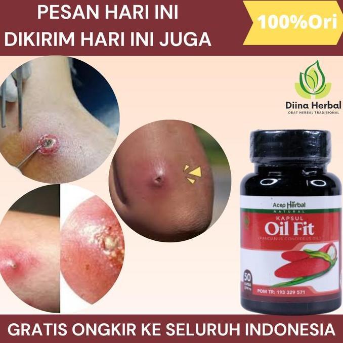 Feminin- Bisulan Dipantat, Bisul Bernanah, Bisul Gak Tumbuh Lagi, Bisul Di Kemaluan, Penghilang Bisu