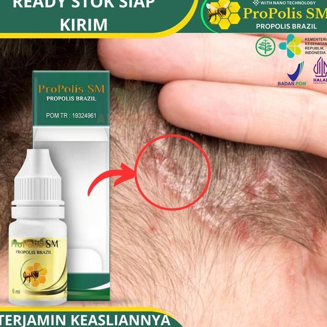 Berkilau- Propolis Sm - Salep Cair Untuk Koreng Gatal Di Kulit Kepala Karena Ketombe Berkerak Dan Be
