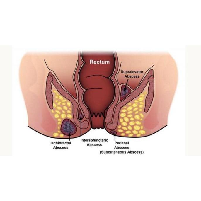 Osso- Wasiri Obat Ambeien Obat Wasir Isi 100 Pil Rekomendasi Sinshe