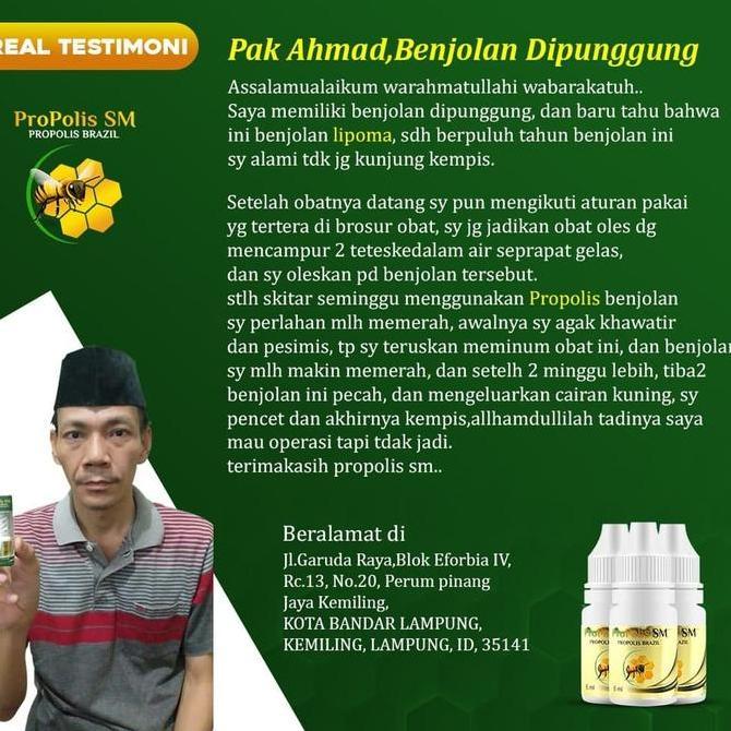 Grosir Propolis Sm Untuk Keloid, Daging Tumbuh, Bekas Luka Menonjol, Pengempes Daging Jadi, Keloid B