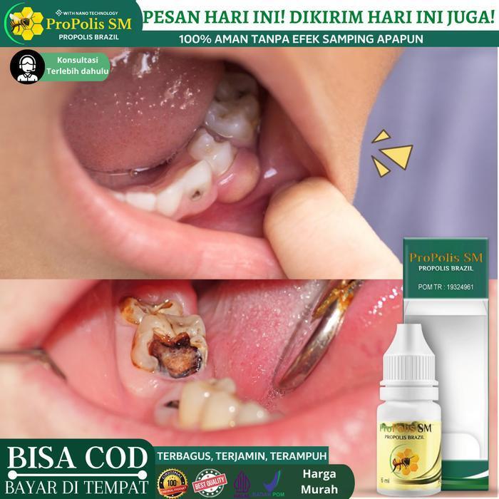 Obat Penghancur gigi Berlubang, Perontok Akar Gigi dan Karang Gigi