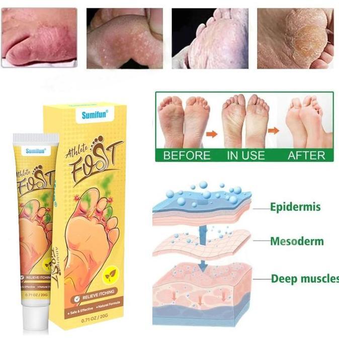 Littlehand- Salep Gatel2 Paling  Obat Telapak Kaki Rayapan 20G Salep Gatal Kulit Ampuh Obat Kaki Ray