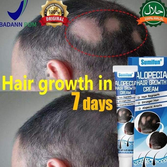 Obat penumbuh rambut Obat Alopecia Areata Rambut Pitak 20g penumbuh rambut cepat serum, penumbuh ram
