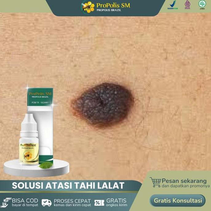 Feminin- Propolis Sm Untuk Tahi Lalat Di Wajah, Tahi Lalat Dileher, Kutil Wajah, Kutil Tangan, Kutil
