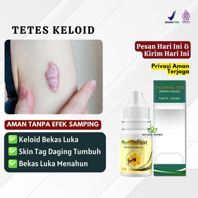 Sale Tetes Keloid Bekas Luka Daging Tumbuh Skin Tag Keloid Bekas Luka Menahun Propolis Sm Perawatan 