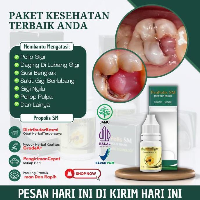 Propolis Sm Solusi Untuk Mengatasi Polip Gigi, Daging Di Lubang Gigi, Gusi Tumbuh Di Lubang Gigi, Po