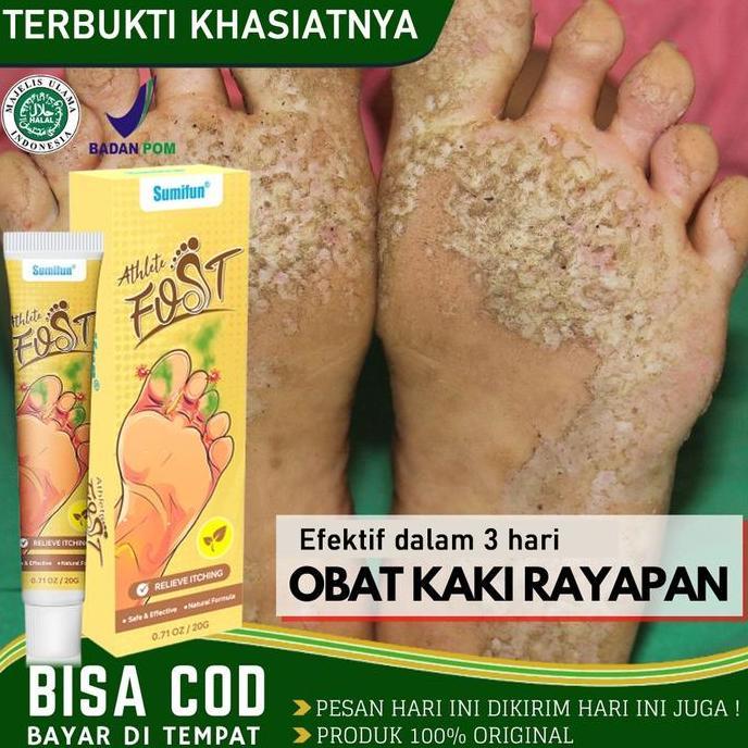 Bytwx- Salep Gatel2 Paling  Obat Telapak Kaki Rayapan 20G Salep Gatal Kulit Ampuh Obat Kaki Rayapan 