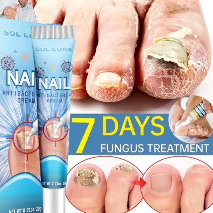 Obat jamur kuku Obat kuku jamur dan rusak Perawatan kuku 20g Pemutih Kuku Penghilang Jamur Kuku Gel 