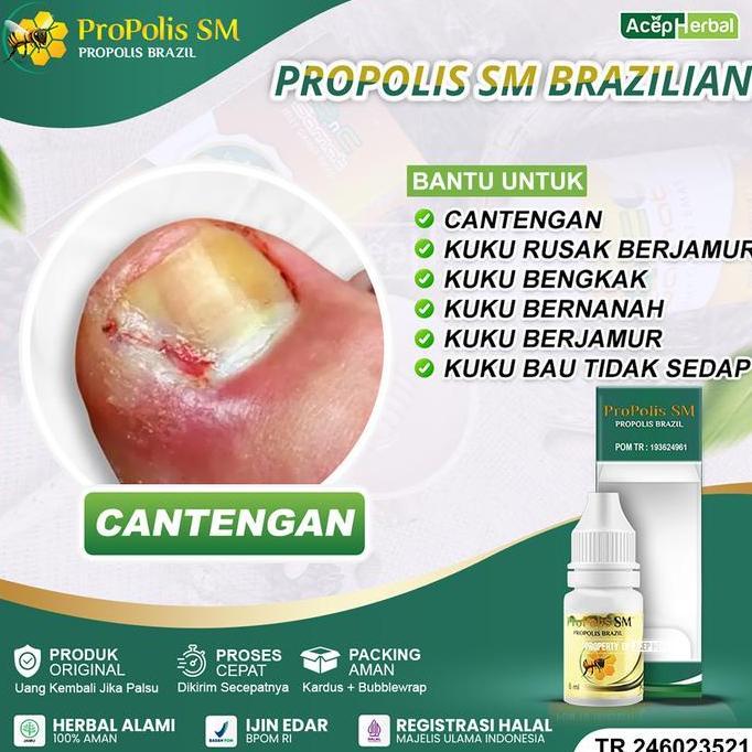 Propolis Sm Oles Kuku Cantengan Kaki Tangan Berjamur Berdarah Bengkak Bernanah Bau Propolis Sm Nail 