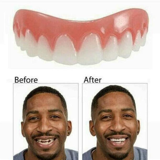 veneer gigi atas dan bawah Premium Grade Original