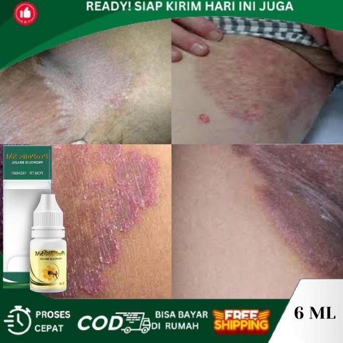 Gatal Selangkangan, Selangkangan Hitam, Selangkangan Gatal Dan Hitam, Ruam Merah Selangkangan, Pemut