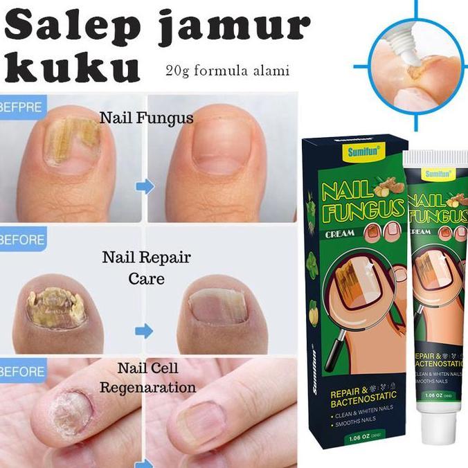 Pickme- Obat Jamur Kuku Obat Jamur Dan Kuku Rusak 20GRegenerasi Perawatan Kuku Kaki Obat Kuku Jamur 