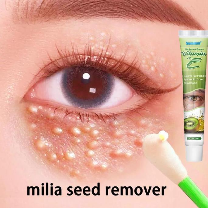 Krim Penghilang Milia Syringoma Xanthelasma Butiran Lemak Sekitar Mata Allshop