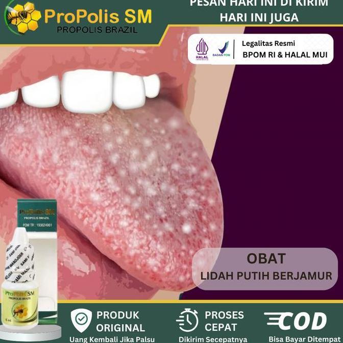 Obat Radang Lidah Putih, Nyeri Pada Lidah, Lidah Bengkak, Lidah Putih Berjamur, Lidah Pecah Pecah, L