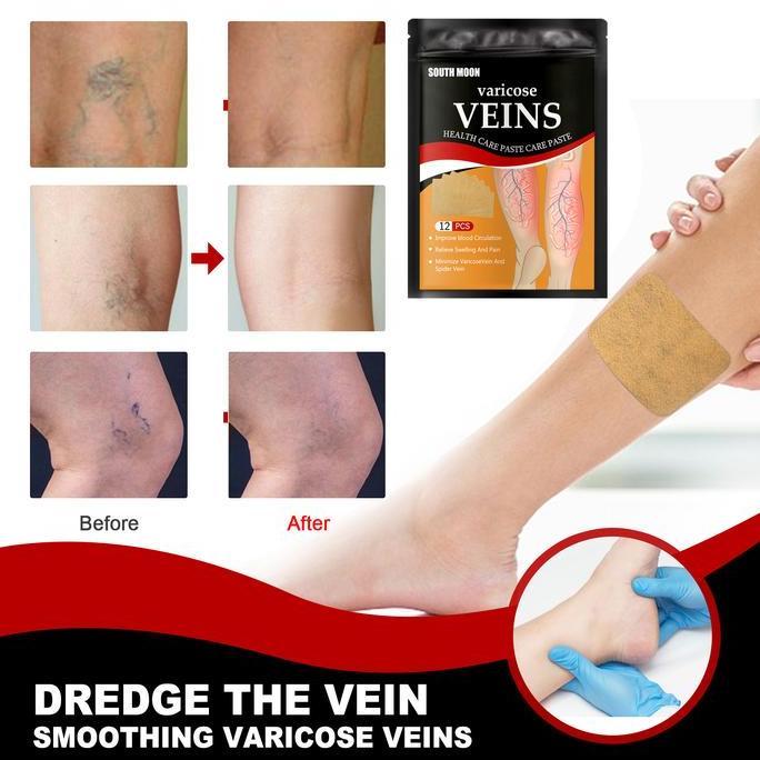 Osso- Varises / Koyo Varises / Varicose Patch / Varicose