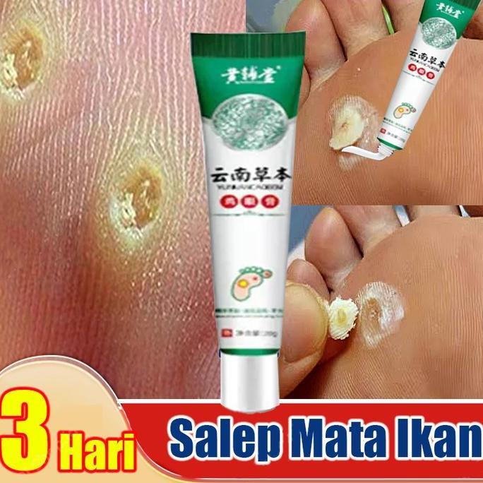 Shiner- Salep Mata Ikan Telapak Kaki /Obat Penyakit Mata Ikan / Obat Mata Ikan Pada Telapak Kaki / K