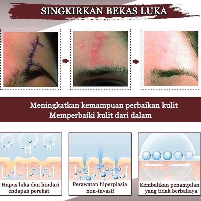 Bytxc- Salep Penghilang Bekas Luka Penghilang Bekas Luka Hitam Koreng Obat Penghilang Bekas Luka Men