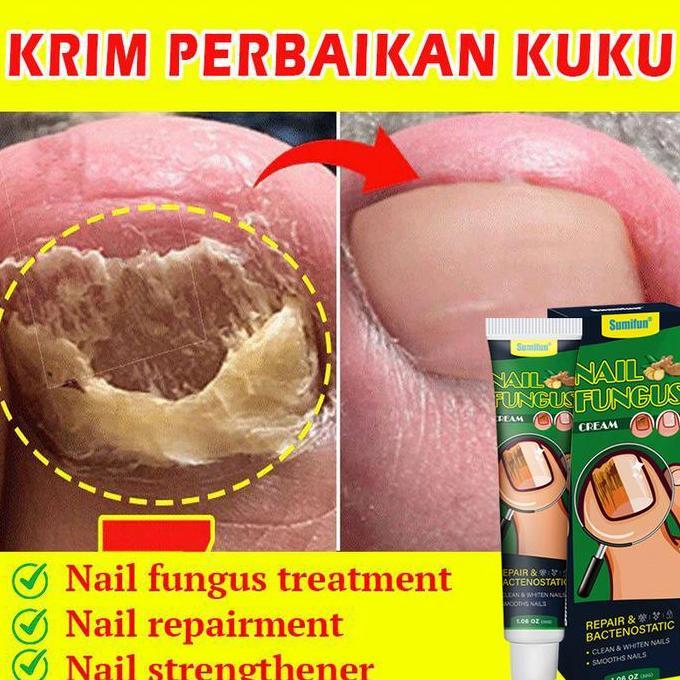 Sumimasen- Obat Jamur Kuku Obat Jamur Dan Kuku Rusak 20GRegenerasi Perawatan Kuku Kaki Obat Kuku Jam