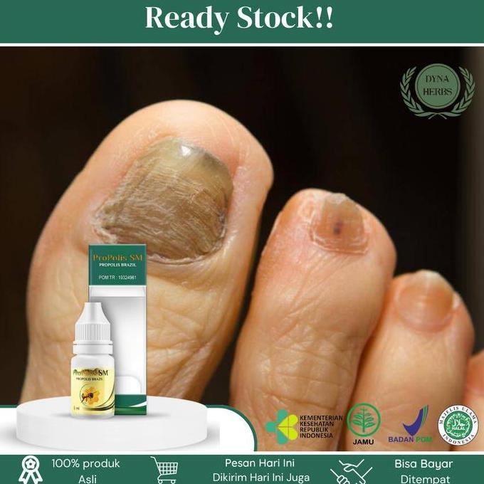Tetes Psoriasis Kuku Berjamur, Infeksi Kuku Rusak Parah Akibat Jamur, Pitting Kuku Berlubang Bergelo