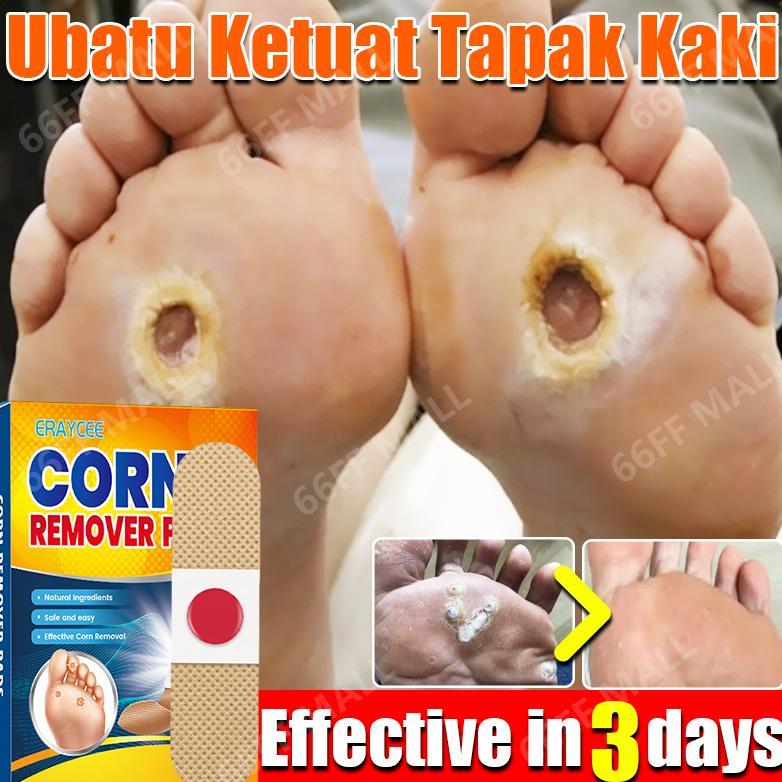 Terlaris plester mata ikan obat mata ikan plester kutil salep mata ikan telapak kaki obat untuk mata