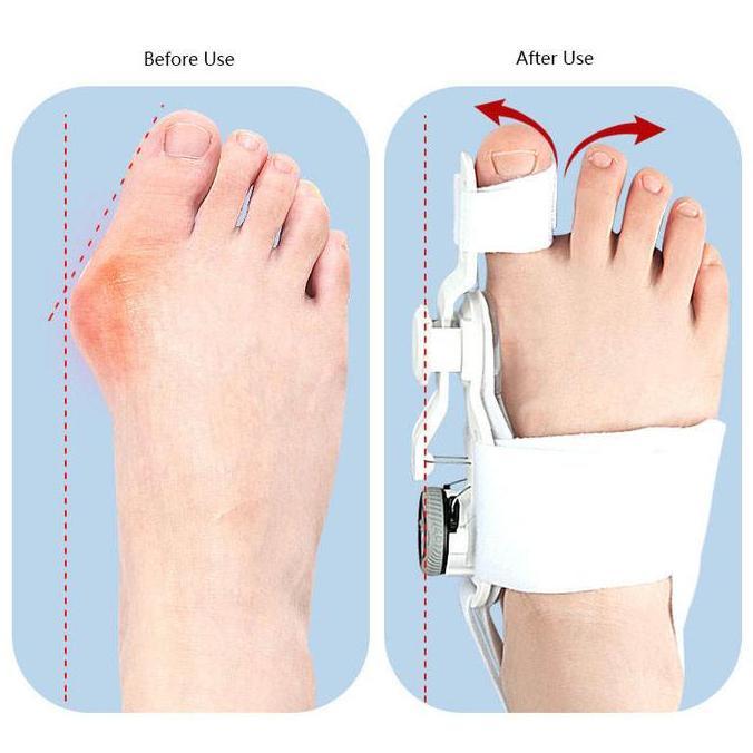 Korektor Pelurus Jempol Kaki Toe Separator Hallux Valgus Bunion Splint Hallux Valgus Footcare Bunion