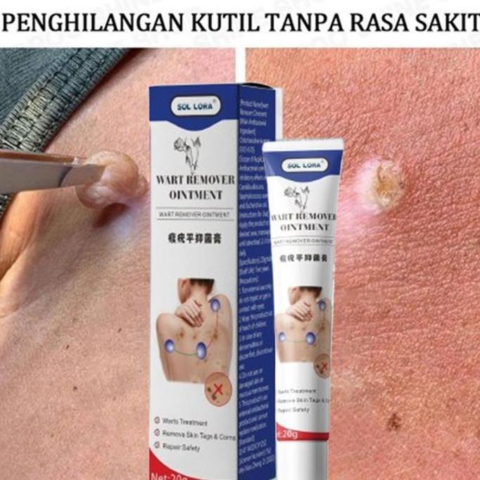 Skinyou- Penghilang Tahi Lalat Dan Kutil 20G Penghilang Kutil Paling Ampuh Penghilang Kutil Obat Kut