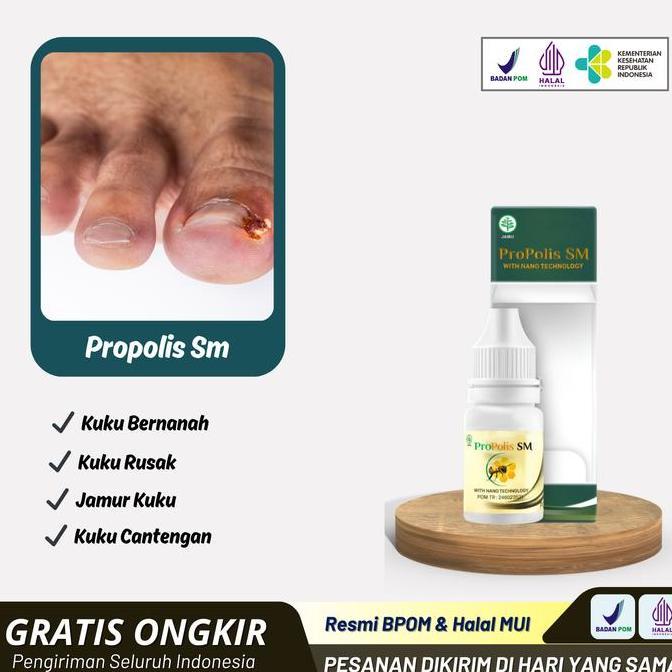 Cantengan Jempol Kaki Kuku kaki Bernanah | Propolis Sm