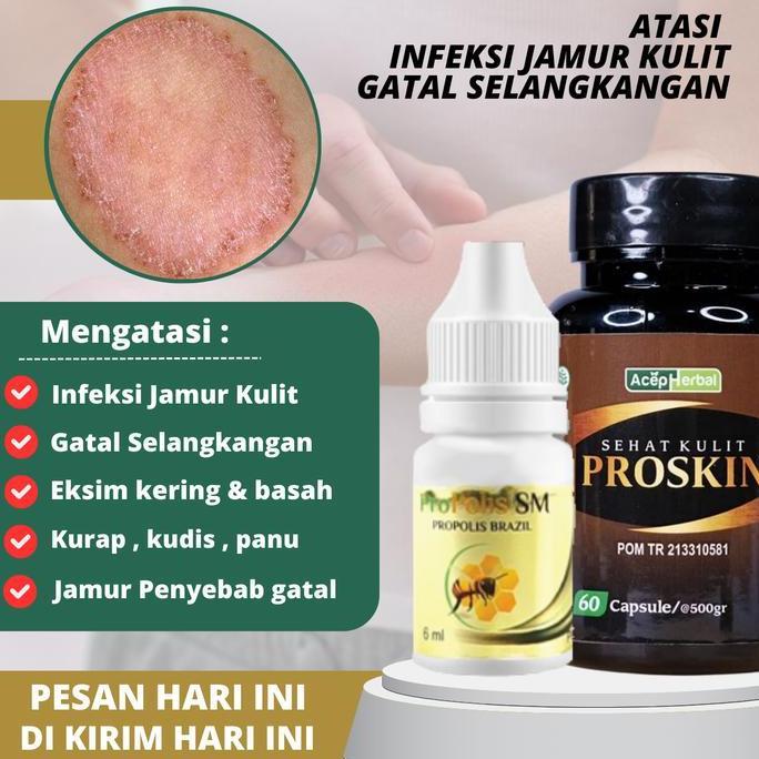 Salep penghilang bekas luka Penghilang luka hitam Menghilangkan luka koreng Penghilang koreng di kak