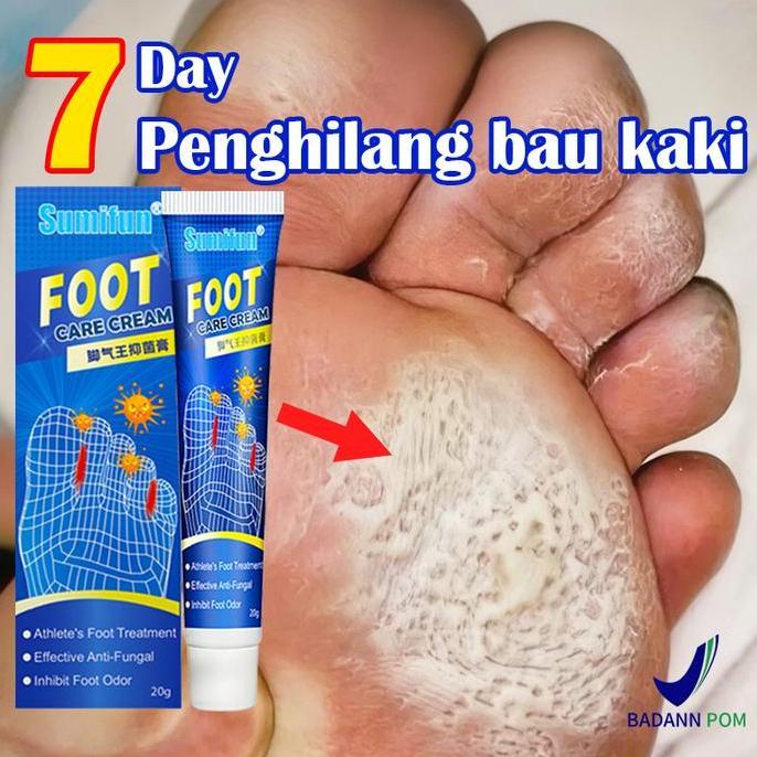 Obat Jamur Kaki Salep penghilang bau kaki Anti Jamur Kaki Gatal&Kurap/obat jamur kaki/Henti gatal ce