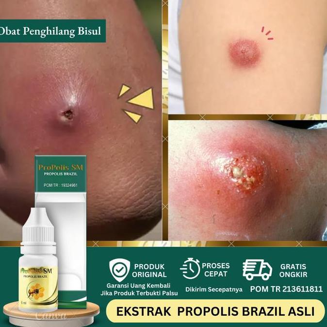 Bisul, Atasi Bisul Agar Tidak Tumbuh Lagi Dengan Propolis SM