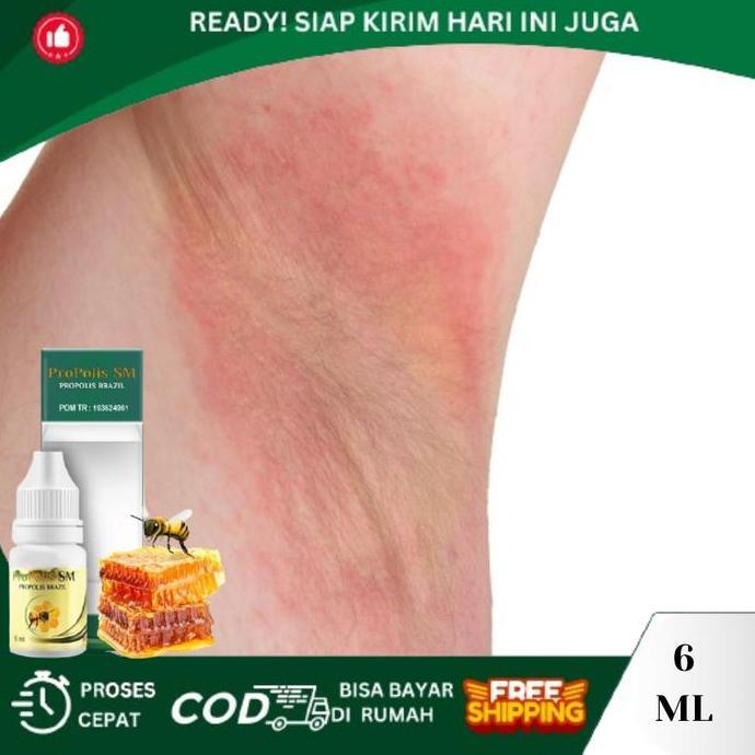 Iritasi Pada Ketiak, Ketiak Gatal, Ketiak Lecet Dan Perih, Gatal Merah Pada Ketiak, Ketiak Berjamur 